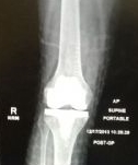 Knee Prostheses: Total, Primary:  Maxx Freedom (Implant 140105)